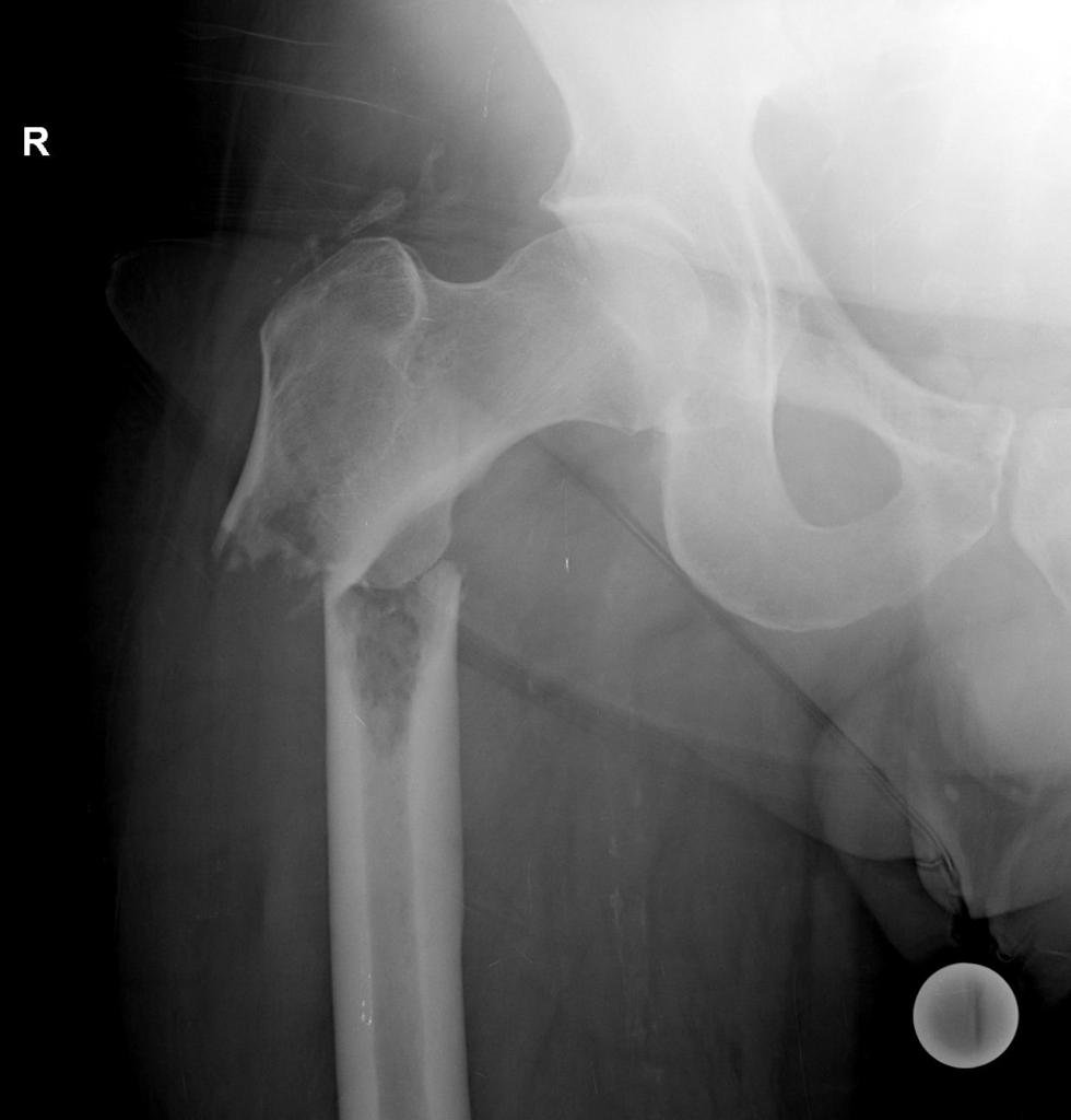 Femur fracture